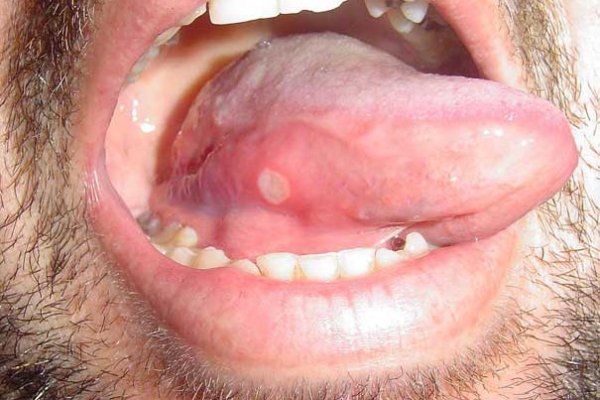 Sores On Tongue From Smoking Crack